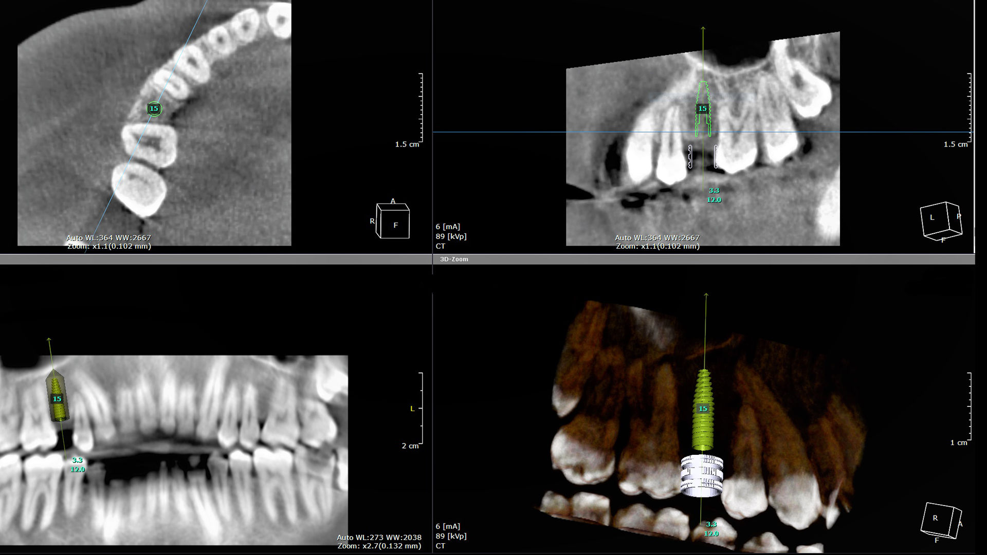 schoen-dentale-implantologie-3.jpg